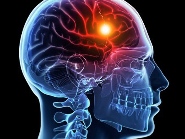 Accident Vasculaire Cérébral - Prévenir et Informer grâce à nos conseils